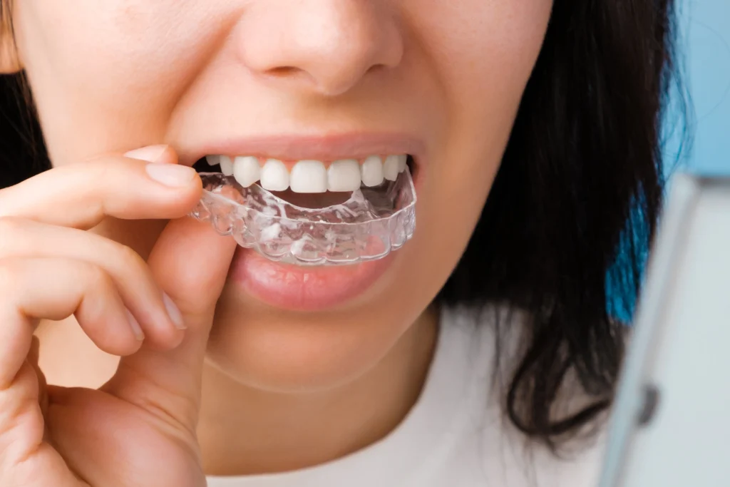 Invisalign Treatment in Tirunelveli